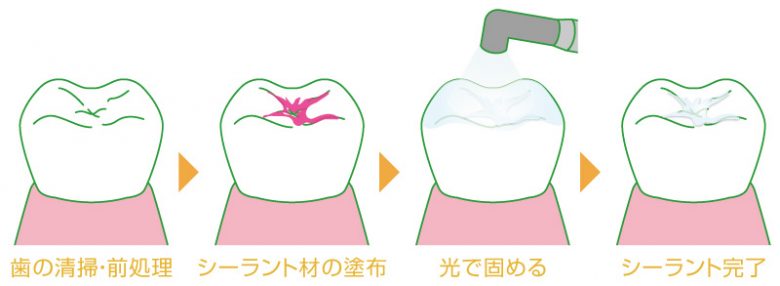 シーラント
