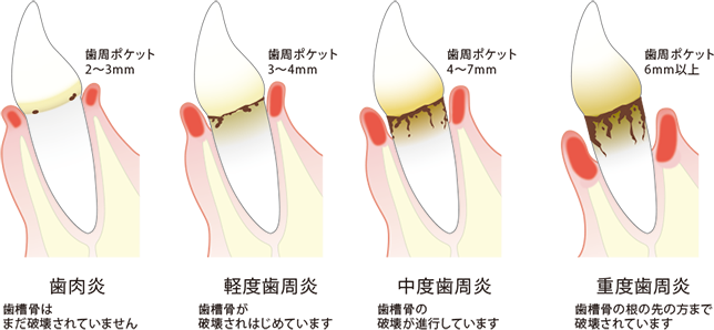 歯周病の進行と歯周ポケット