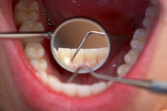 半年に1回の歯科検診とクリーニングの必要性