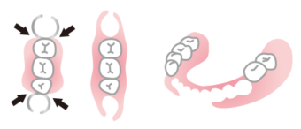 ノンクラスプデンチャー（保険適用外）