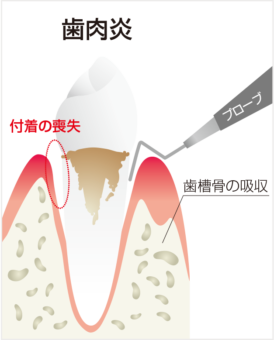 歯周ポケットの測定